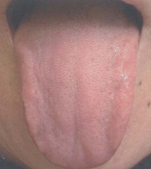 【舌象特征】舌体颜色淡红润泽,白中透红(图2